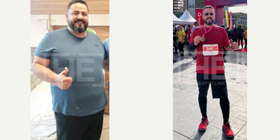 35-44 year old man treated with Gastric Bypass, Gastric Sleeve Surgery - He lost 46 kilos in 12 months with Gastric Sleeve Surgery.