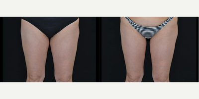 Woman treated with Vanquish - Woman treated with Vanquish