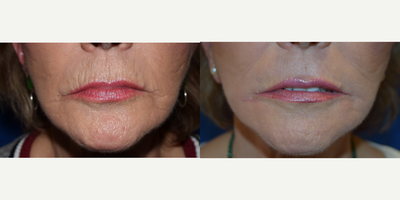 65-74 year old woman treated with Dermabrasion - Perioral Dermabrasion Results.