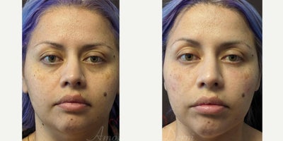 35-44 year old woman treated with Juvederm, Volbella, Voluma, Restylane - 4D Under Eye Lift - Treatment of dark circles & bags under eyes and cheek restoration with Belotero, Restylane, Volbella and Voluma