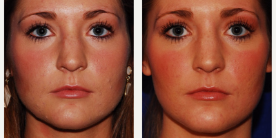 25-34 year old woman treated with Jaw Reduction - Botox jawline slimmingBotox masseter reductionBotox jaw reduction

Stephen Weber MD, FACSWeber Facial Plastic SurgeryDenver, Colorado