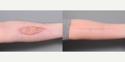Arm Scar Revision - This is a 28-year-old man who came to the office requesting revision of skin grafts on both arms. He had some large tattoos in this area when he was young and foolish. After attempting multiple rounds of laser tattoo removal he says his skin began to scar from the laser and he was told that he would always have a shadow from the original tattoo.His next stop was to a local plastic surgeon to have the marks surgically excised. That surgeon told him that he would not be able to close the wounds because they were too large but instead offered to skin graft the areas. The before pictures above represent those skin grafts, but they look just like scars to the patient. I offered him complete removal of the old skin grafts and primary (direct) closure. Postoperatively, he followed a rigid support program with taping of the wounds as well as application of silicone gel. His results are shown about 8 months after I revised the skin grafts.