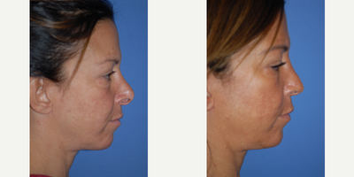 35-44 year old woman treated with Revision Rhinoplasty - Over rotation improved