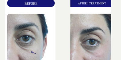 45-54 year old woman treated with Fractora RF, Forma, Facial, Skin Tightening, Skin Rejuvenation - FRACTORA FIRM-FORMAbipolar radiofrequency
