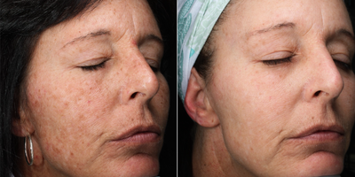 45-54 year old woman treated with Pico Genesis - Patient wanted sun spots to dissipate and to refreshen the skin.