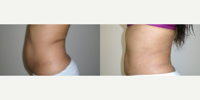35-44 year old woman treated with Smart Lipo - pre and post PAL
