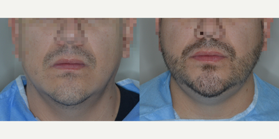 Man treated with Beard Transplant - 2,000 FUE grafts to beard