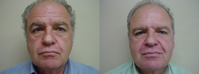 Botox - 	Botox to help with excessive sweating on forehead