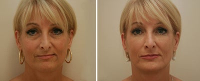 Injectable fillers & Botox Injections - Patient received a combination of Restylane (under eye area and mouth) and Botox to soften lines, reduce dark circles under the eye and restore volume to the cheeks and temples.