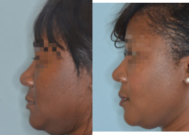 Patient Case #8960 - Female, African American patient who desired refinement to her nose. Her main concerns included her bulbous tip and the flare of the base of her nose. Primary rhinoplasty techniques included osteotomies, caudal septal extension graft for tip support, tip graft, and alar flare reductions.