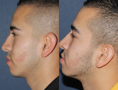 Before & After V-Beam Treatment - 	Patient undergoes birthmark removal using the V-Beam laser to achieve optimal results.