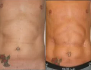 35-44 year old man treated with Body Jet - 40 year old male wanted improved abdominal definition.