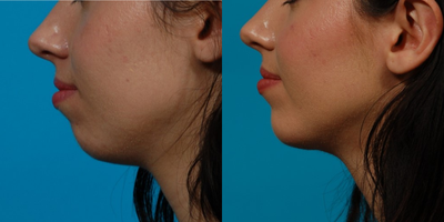 Woman treated with Chin Implant - Woman treated with Chin Implant