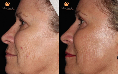 Female Patient Treated for Wrinkles and Texture with C02RE Fractional C02 Resurfacing Treatment - 	3 Months post CO2RE Fractional C02 Resurfacing Treatment