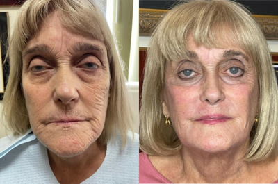 65-74 year old woman treated with MiXto Laser - Mixto fractional Co2 laser resurfacing was combined with Ultherapy and fillers (Restylane, Juvederm and Radiesse) for what I call a liquid facelift. No cutting was performed and healing time is about 5-7 days.