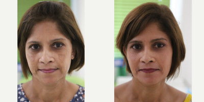 35-44 year old woman treated with Cosmelan - Very happy patient treated with Cosmalan at Dr SW Clinics for her facial pigmentation.
