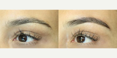 35-44 year old woman treated with Microblading, Permanent Makeup - Microblading is a precision-based form of cosmetic tattooing designed to enhance and restore natural brow shape. Each treatment is performed by Ruth Swissa, CMM, a leading expert in medical micropigmentation.Using a sterile, single-use microblade, ultra-fine pigment is deposited into the superficial dermis to create realistic, hair-like strokes that blend seamlessly with existing brow hair. Each procedure includes a detailed facial analysis and custom brow mapping to ensure symmetry, balance, and a tailored result.Ideal for patients with thinning brows, asymmetry, or hair loss, microblading delivers soft, natural-looking enhancement with results that continue to refine as the pigment settles. *A follow-up session is recommended to perfect the final outcome.