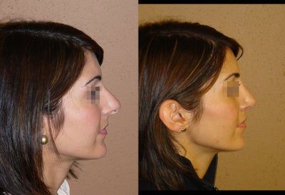 Rhinoplasty/nose job surgery - 
	revision rhinoplasty is always more difficult than primary procedures but maybe rewarding in some cases
