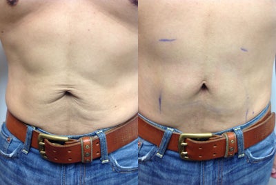 Skin Tyte Works - This patient had a 50 pound weight loss and the skin on the lower abdomen had lost enough elasticity to not fully recover. These pictures were taken before and immediately after one Sciton SkinTyte treatment. This system really works! We recommend 3-4 treatments 3-4 weeks apart to create a long lasting result. Areas showing best response include neck, jowls, abdoment, inner arms: anywhere there is moderate loose skin laxity that is not eligible for surgical reduction.