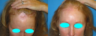 53 Year Old Female previously treated with skin graft after skin cancer removal - 53 year old female who had previously had a large skin cancer removed on her forehead/ hairline area. The defect was initially repaired with a full thickness skin graft by another Surgeon. The patient presented to my office 1 year later requesting scar revision. The skin graft and old scar were removed and the area reconstructed with an O to T closure. The postoperative picture is 3 months later.