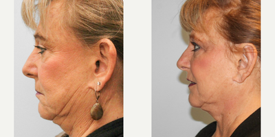 55-64 year old woman treated with Ear Surgery - This woman in her early sixties had insecurities surrounding the prominence of her ears and desired an otoplasty. Sheis shown before and one month after surgery.