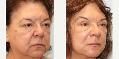 65-74 year old woman treated with Lip Lift - This woman in her late sixties had concerns around the droopiness of her jowls, neck, and facial skin. She discussed her interests with the doctorand together they decided she would be a good candidate for a facelift, upper lid blepharoplasty, and upper lip lift. She has healed very well and is featured before and three months after surgery.