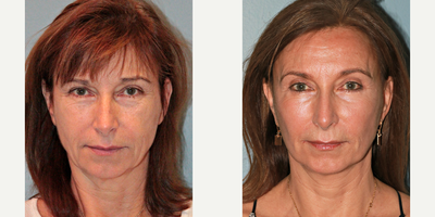 55-64 year old woman treated with Lifestyle Lift - This patient underwent LiteLife, Lifestyle Face Lift, blue peel, facial fat transfer, and upper and lower eyelids. She had little bruising or swelling at 3 weeks post-op, this is one of the many benefits of our LiteLift face lift procedure. Results are also very natural as you can see in her pictures. After photos were taken 9 months post-op.
