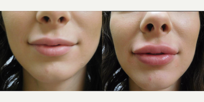 25-34 year old woman treated with Restylane Lyft - This 29 year old female was unhappy with the deflated appearance of her lips. Dr. Rottman performed lip augmentation with one syringe of Restylane Lyft to create the look she desired.