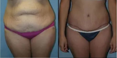 Woman treated with Tummy Tuck - Woman treated with Tummy Tuck.