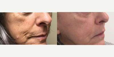 65-74 year old woman treated with Secret RF - This patient who is 72 years old came in to discuss non-invasive options to target fine lines, wrinkles, and sagging skin. Upon the consultation it was determined that she would be a great candidate for Secret RF; microneedling with radio frequency. This patient received three treatments that were spaced out 4-6 weeks each time. The photos shown above are before and after just two treatments.