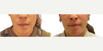 Woman treated with Jaw Surgery - Woman treated with Jaw Surgery.