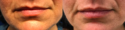 45-54 year old woman treated with Juvederm - Juvederm injection in theupper and lower lips.