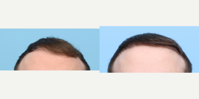 25-34 year old man treated with FUE Hair Transplant, Hair Transplant, Hair Loss Treatment, PRP for Hair Loss, NeoGraft - This 34-year-old patient came to Dr. Wise seeking a solution for hairline recession and a lack of hair density. To address these issues, Dr. Wise performed an FUE hair transplant and one PRP therapy session. One year after the procedure, the patient's hairline has been fully restored and their hair density has significantly improved.