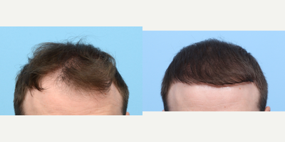 25-34 year old man treated with FUE Hair Transplant, Hair Transplant, Hair Loss Treatment, PRP for Hair Loss, NeoGraft - This 34-year-old patient came to Dr. Wise seeking a solution for hairline recession and a lack of hair density. To address these issues, Dr. Wise performed an FUE hair transplant and one PRP therapy session. One year after the procedure, the patient's hairline has been fully restored and their hair density has significantly improved.