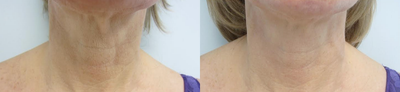 45-54 year old woman treated with Infini RF - 45-54 year old woman treated with Infini RF