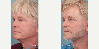Man treated with Facelift Revision - Man treated with Facelift Revision