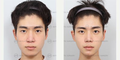 25-34 year old man treated with Double Eyelid Surgery, Canthoplasty, Jaw Reduction, Genioplasty, Revision Rhinoplasty, Asian Rhi - Non-Incisional Ptosis Correction, Epicanthoplasty, Lateral CanthoplastyMandible Jaw Reduction, Genioplasty, Buccal Fat RemovalRhinoplasty Revision (Nose Ridge+Nose Tip+Osteotomy+Bulbous Nose Correction+Weir Reduction+Donated Rib Cartilage)