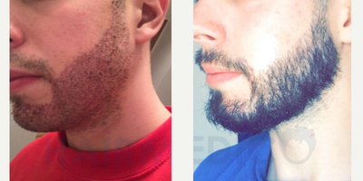 25-34 year old man treated with Beard Transplant - Patient's Age: 32Beard TransplantFUE Technique2900 grafts10 months result