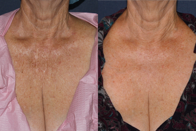 66 year old female chest treated with Fraxel Repair for wrinkles, texture, sun damage - 
	This is a 66 year old female chest whose chest Dr. Groff treated with Fraxel Repair for wrinkles, texture, sun damage. Notice significant improvement in all facets. Dr. Groff did one treatment on this patient
