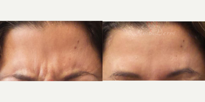 45-54 year old woman treated with Botox, Jeuveau, Dysport, Xeomin - Botox injection for treatment of lines and wrinkles in forehead and frown lines (can also be done with Dysport, Jeuveau or Xeomin)