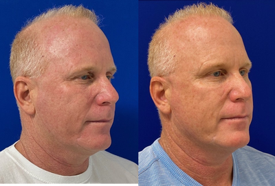 52 year old man treated with FUE Hair Transplant - My 52 year old patient 7 months post FUE hair transplant. Patient receive approximately 2,000 grafts.