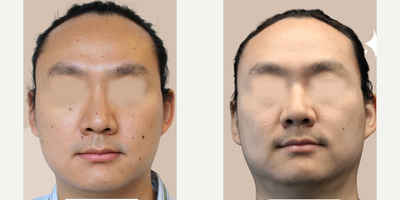 Man treated with Mole Removal - This patient had many moles removed with lasers and the patient's face looks much clearer! See what a difference mole removals can make on a persons appearance!