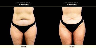 25-34 year old woman treated with Butt Augmentation - 25-34 year old woman treated with BBL (Brazilian Butt Lift)