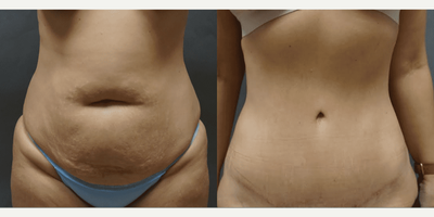 Woman treated with Tummy Tuck - Woman treated with Tummy Tuck