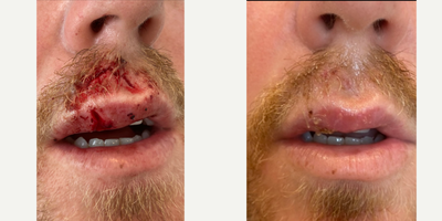 35-44 year old man treated with Biocorneum - Male patient with laceration type scar on the lips treated with a combination of surgery repair, laser, and Plato's Scar Serum.