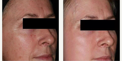 Woman treated with Infini RF - Woman treated with Infini RF