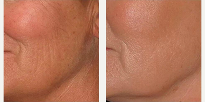 Woman treated with Infini RF - Woman treated with Infini RF