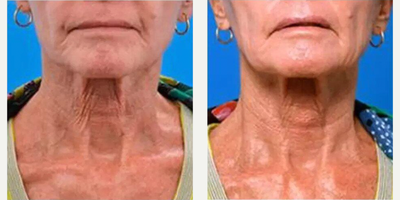 Woman treated with Infini RF - Woman treated with Infini RF