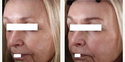 Woman treated with Infini RF - Woman treated with Infini RF