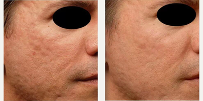 Woman treated with Infini RF - Woman treated with Infini RF